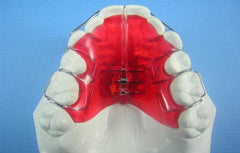 Schwartz Distalizser Orthodontic appliance Model
