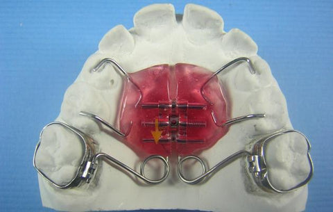 Pendex Distalizer Orthodontic Model