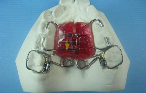 T-Rex Distalizer Orthodontic Model
