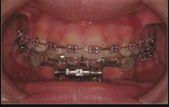 Distraction Osteogenesis model