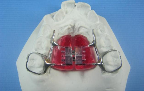 rapid palatal expander orthodontic model