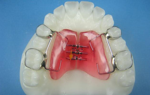 Haas Rapid Palatal Expander ortho model