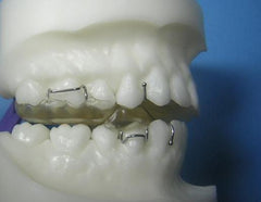 Twin Block Orthodontic Model