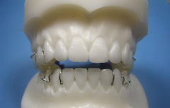 Twin Block Orthodontic Model