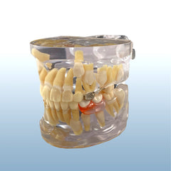 orthodontic space maintenance model