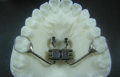 Temporary Anchorage Devices (TAD) Orthodontic Model #2