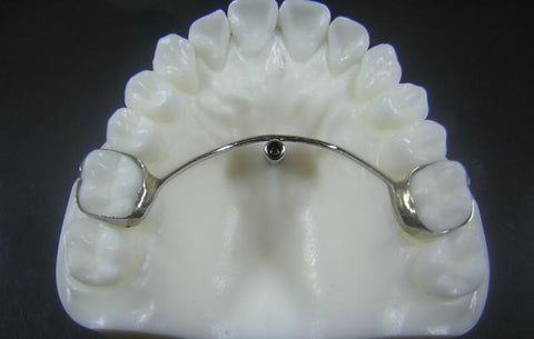 Temporary Anchorage Devices (TAD) Orthodontic Model #3