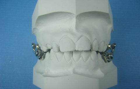 Telescoping Herbst Orthodontic Model