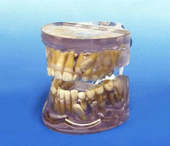 orthodontic model impacted cuspid canine teeth