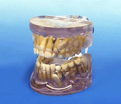 orthodontic model impacted cuspid tooth