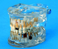 incisor tooth lingual eruption model