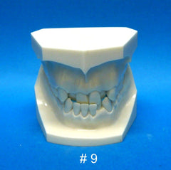 malocclusion orthodontic model 