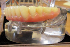 overdenture model