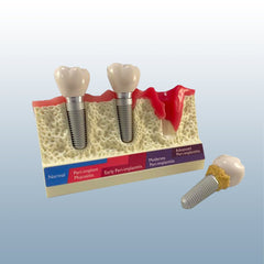 periodontal implant mucositis model