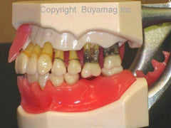 Periodontal Disease Model  Gum Bone Loss