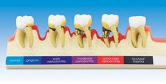 Periodontal Disease Demonstration Model 2x Enlarged Size