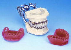 periodontal model with calculus on teeth