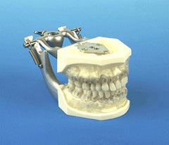 Replacement Teeth set with calculus