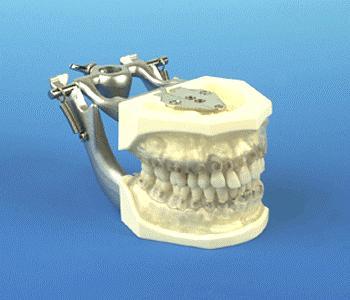 Periodontal Hygiene model