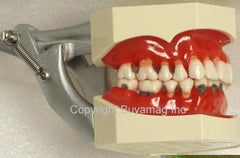 periodontal recession Model