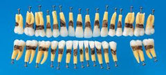 peridontal teeth replacement