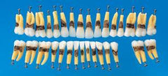 Replacement Teeth set with calculus