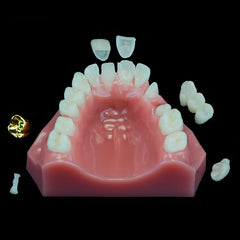 Dental Restoration Gold Crown Bridge Inlay Veneer Onlay Model