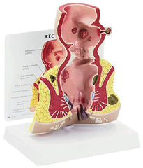 human rectum pathology model