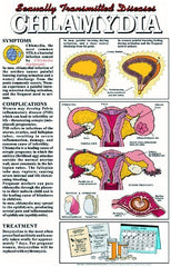 Chlamydia Poster Safe Sex Poster Charts
