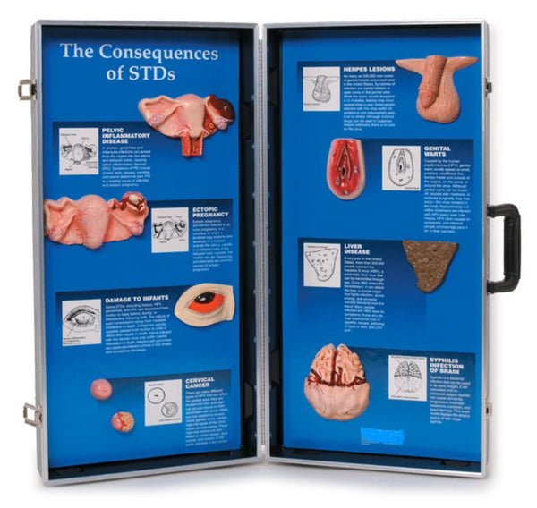 Safe Sex Consequences of Sexually Transmitted Diseases Model Folder Display Portable