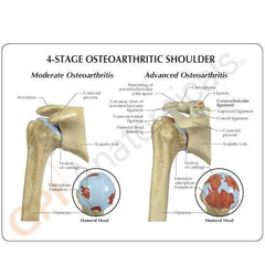 Shoulder Joint4 Stage Osteoarthritic Degeneration