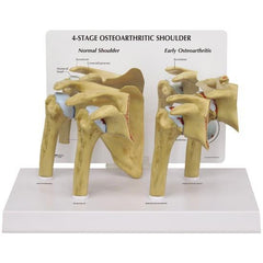 Shoulder Joint4 Stage Osteoarthritic Degeneration