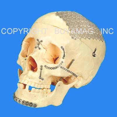 Skull Craniofacial Surgery Cranium Reconstruction Titanium Modular Implants  Devices  Simulator  Academy  Educational  Model