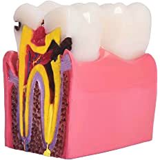 Teeth Caries Gum Disease Model With Bone Loss Dental Oral Pathologies