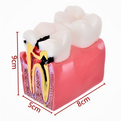 Teeth Caries Gum Disease Model With Bone Loss Dental Oral Pathologies