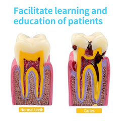 Teeth Caries Gum Disease Model With Bone Loss Dental Oral Pathologies