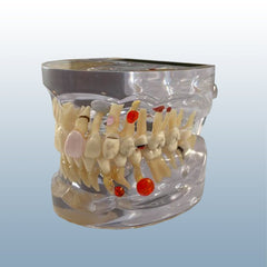 teeth disease resoption pulp model