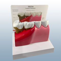 disease teeth gums pathologies model 