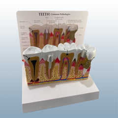 disease teeth gums pathologies model 