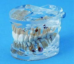 Teeth pathologies resoption fractured tooth model