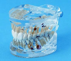 teeth abscess pulp polyp radicular pulpitis enamel pearl supereruption model