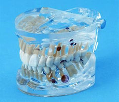 teeth abscess pulp polyp radicular pulpitis enamel pearl supereruption model
