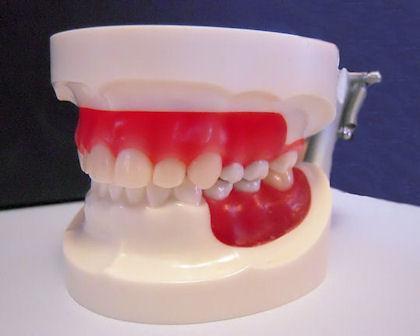 Dental Typodont Model Epoxy Resin Wax