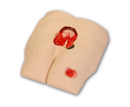 Buttocks wound Pressure sores Ulcer Model 