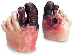 diabetic neuropathy foot wounds model