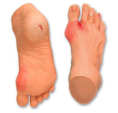 foot diabetic wound model