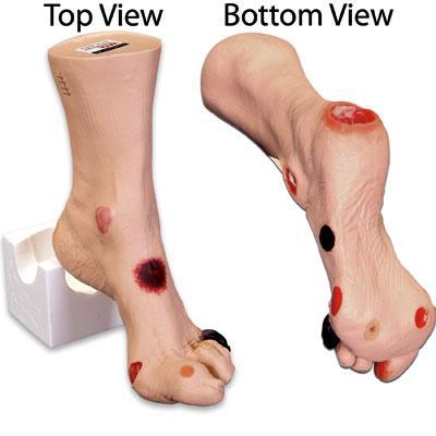 Diabetic neuropathy foot wounds model 